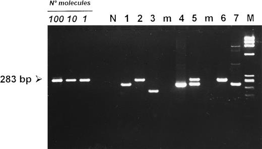 Fig. 4. Detection of deletions at the carboxy terminal region of the LMP-1 gene in PBMCs from HIV-seronegative donors (lanes 1 to 3) and HIV-infected patients (lanes 4 to 7 ). Cases 2 and 6 carried a full-length LMP-1 fragment of 283 bp. PBMCs from cases 1, 4, and 7 showed a smaller fragment consistent with a 30-bp deletion. Case 5 showed the concomitant amplification of a full-length and a deleted LMP-1 fragment, whereas case 3 carried a deletion larger than 30 bp. (N) DNA from an EBV-negative squamous cell carcinoma of the head and neck. (M) HaeIII-digested DNA of X-174-RF as a molecular-weight marker. Amplification of 100, 10, and 1 target molecule is also included to show the sensitivity of the seminested PCR protocol used.