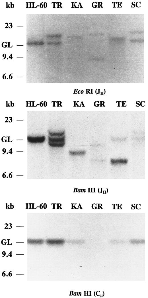 Fig. 1. Southern blot analysis of IgH chain rearrangements in five cases of IgA and/or IgG CLLs. DNAs were digested with EcoRI and BamHI restriction endonucleases and probed with JH and Cμ. The migration of germline (GL) DNA as well as molecular-weight markers are indicated.