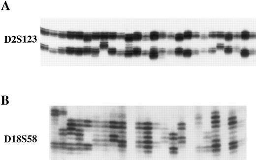 Fig. 6. Representative results of analysis of microsatellite instability in single cell clones of KCL22. Single cell clones of KCL22 exhibit microsatellite instability at D2S123 (A) and D18S58 (B). Each lane represents an independent subclone. DNA samples were prepared from single cell clones isolated by limiting dilution, and polymorphic microsatellite sequences were amplified by PCR and analyzed in denaturing sequencing gels. Subclones of KCL22 display different patterns of laddering at both polymorphic microsatellites.