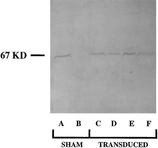 Fig. 2. SDS-PAGE immunoblot detection of p67phox protein in 17-day cultures of nontransduced (sham) and transduced CD34+ PBHP. Lane A analyzes a sham treated culture of normal CD34+ cells. Lane B analyzes a culture of p67phox deficient CGD sham treated patient CD34+ cells, lanes C-F analyze cultures of p67phox deficient CGD patient cells transduced with virus derived from MFGS-p67phox clones 2, 5, 20, 37, respectively.