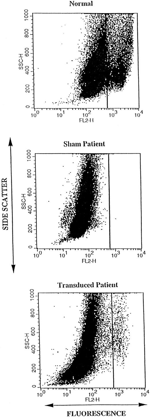 Fig. 4. Dot plot of the DHR FACS oxidase analysis of 17-day cultures of differentiating CD34+ cells. Each dot represents a single “event” (cell) analyzed for side scatter (granularity) plotted in linear scale on the vertical axis, and for fluorescence (oxidant production) plotted in log scale on the horizontal axis. The analysis was gated to include all live cells in the cultures following loading with DHR and activation with PMA. The top panel shows analysis of a typical sham treated normal CD34+ 17-day culture. In this normal CD34+ cell culture, two clusters of cells can be seen that are separated by the vertical line. The large cluster on the left represents immature cells with low-oxidase activity, whereas the smaller cluster to the right represents mature granulocytes (as determined by sorting) with high oxidase activity. The middle and lower panels show analyses of sham treated and MFGS-p67phox transduced p67phox deficient CGD CD34+ cultures, respectively. Mature granulocytes with high oxidase activity are only seen in patient cultures after transduction as in the lower panel.