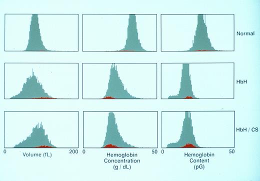 Fig. 2. Parameters for the RBCs and reticulocytes from a normal patient, a patient with classical HbH, and a patient with classical HbH/CS. The distribution curves for the entire RBC population are shown in gray, whereas the reticulocyte population is displayed in red.