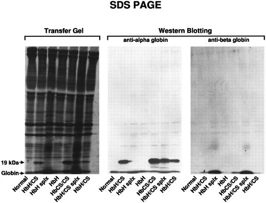 Fig. 4. The left panel (Transfer Gel) identifies the SDS-PAGE analysis of solubilized membranes of normal controls, patients with HbH, HbH/CS, and patients with homozygous HbCS/CS. Splenectomized patients are indicated by splx. The globin band, running at approximately 15 kD, appears at the bottommost portion of the gel. The arrow indicates bands seen only in HbCS variants that run at a position consistent with 19 kD molecular weight. Western blotting of similar patients is shown on the two righthand panels with a monoclonal anti–α-globin in the center and anti–β-globin MoAb on the right. The anti–β-globin antibody shows accumulations of β-globin in HbH and HbH/CS, but the largest accumulations occurred in splenectomized patients with HbH and HbH/CS. Of importance is the fact that the anti–α-globin antibody reacted specifically with the 19-kD band.