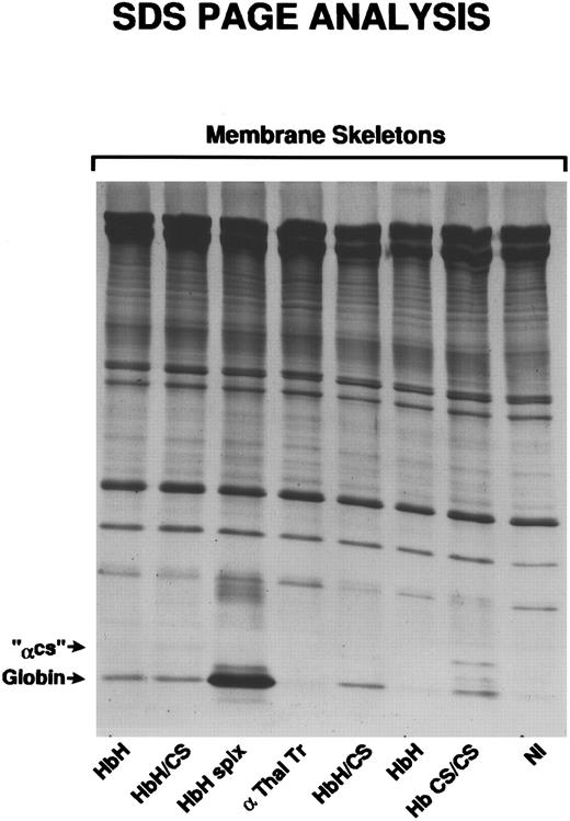 Fig. 5. Membrane skeletons, prepared as described, were subjected to SDS-PAGE analysis. Characteristic of membrane skeletons is the prominence of α- and β-spectrin, band 4.1, and actin. Relatively faint bands identified as αCS, because of their position at 19 kD, are seen only in the two patients with HbH/CS and the patient with HbCS/CS.