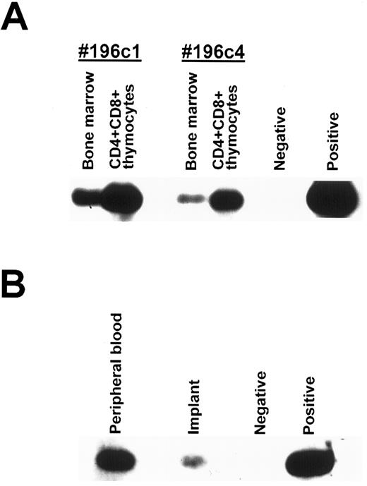 Fig. 5. Detection of neo gene by PCR analysis of sorted human cells. (A) Human CD45+CD4+CD8+ cells were sorted from the thymic implants of 2 BM-thy-SCID-hu mice transplanted with HFBM transduced with the neo-containing MY-2 vector. The cellular DNA from the sorted human CD45+CD4+CD8+ thymocytes and from the mouse BM was extracted and assessed for integrated retrovirus by PCR with a neo-specific primer pair. (B) Human CD45+CD4+CD8− cells were sorted from the thymic implant and PB of a BM-thy-SCID-hu mouse transplanted with HFBM transduced with the neo-containing MY-2 vector and the DNA was extracted and assessed for integrated retrovirus by PCR with a neo-specific primer pair. Southern blots using an intervening sequence probe specific for the neo primer pair-amplified product are shown.