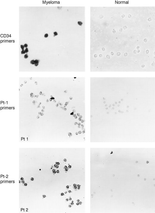 Fig. 3. In situ RT-PCR amplification of CD34 or clonotypic IgH VDJ mRNA in sorted CD19+ MM or normal donor B cells. Sorted CD19+ MM, CD34+19+ MM, or normal donor PBMC were placed on slides and using primers to CD34 (top row, CD19+ MM PBMC or normal CD19+ PBMC) or to patient-specific IgH VDJ (middle row, Pt-1 primers on MM Pt-1 CD34+19+ PBMC or normal PBMC CD19+ B cells; bottom row, Pt-2 primers on MM Pt-2 CD34+19+ PBMC or normal CD19+ PBMC B cells), mRNA was amplified using digoxygenin-labeled nucleotide, followed by visualization with antidigoxygenin antibody in a colorimetric assay. The experiment of the top row used a blue dye, Nitro blue tetrazolium chloride, as substrate while the experiment of the middle and bottom rows used Fast Red as the substrate. Positive cells exhibit intense color deposition. MM CD34+19+ blood cells are shown in column 1 (left) and CD19+ B cells from blood of normal donors in column 2 (right).