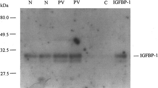 Fig. 4. Ligand blot of circulating IGFBP-1 in normal individuals and patients with PV. A representative ligand blot shows plasma levels of IGFBP-1 in PV patients and normal individuals (N). Plasma samples from 2 PV patients and 2 age- and sex- matched normals were used to immunoprecipitate IGFBP-1 and these were separated by SDS-polyacrylamide gel electrophoresis under nondenaturing conditions, transferred to nitrocellulose membrane, and ligand blotted with 125I–IGF-I. The membrane was then washed and used to expose x-ray film. Recombinant human IGFBP-1 (UBI) was run as a positive control and C indicates a negative control for the antibody used. Relative molecular weights are shown in kilodaltons and were determined by prestained molecular weight markers (Bio-Rad). The position of the putative nonphosphorylated (30 kD) IGFBP-1 species is indicated. Using densitometric analysis, we found the amounts of nonphosphorylated IGFBP-1 in the 2 normal samples to be 1.021 and 1.167, respectively, in arbitrary units; in the 2 PV patients, the amounts were found to be 2.897 and 3.115, respectively, whereas in the recombinant control, it was 1.067. The amounts of the phosphorylated IGFBP-1 species (28 kD) were 0.188 and 0.256 in the 2 normal subjects, respectively; in the 2 PV patients, they were 0.707 and 0.736, respectively, whereas in the recombinant control it was 0.292. The ligand blots confirm that the level of circulating IGFBP-1 in PV is greater than in normal.