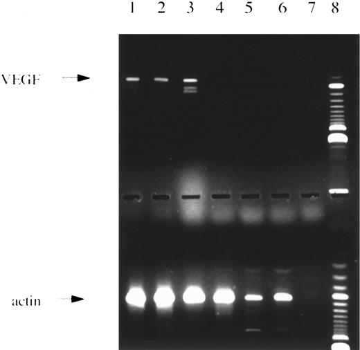 Fig. 1. PCR analysis. (Upper panel) Amplification with VEGF-specific primers showing the 3 major splice variants. Lanes 1 through 4 and 6, patients with AML; lane 5, normal bone marrow; lane 7, water control; lane 8, 100-bp ladder size marker. (Lower panel) Same c-DNAs as in lanes given above amplified with actin-specific primers.
