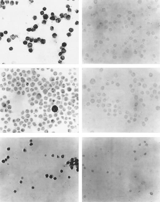 Fig. 2. (Left side) Immunocytochemistry with a polyclonal antibody against VEGF. (Right side) Control reactions with the VEGF antibody after preabsorption with specific peptide. (Upper panel) Cell line U 937. (Middle panel) Cell line TF-1. (Lower panel) Cells from a representative patient with AML. VEGF expression in all three cases. (Original magnification × 100.)