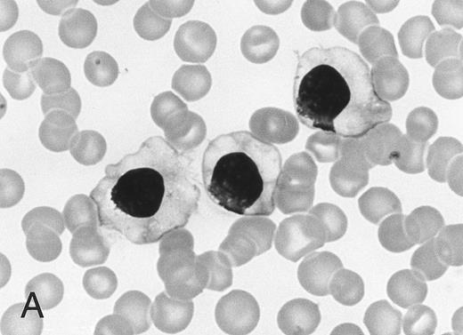 Fig. 1. Morphology of peripheral blood mononuclear cells in HBLD (A) and in HCL-Japanese variant. (B). (May-Grünwald-Giemsa.)