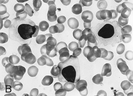 Fig. 1. Morphology of peripheral blood mononuclear cells in HBLD (A) and in HCL-Japanese variant. (B). (May-Grünwald-Giemsa.)