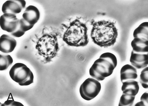 Fig. 2. (A) Phase-contrast micrograph of peripheral blood lymphocytes in HBLD. The cells display striking surface projections. (B) Scanning electron micrograph shows prominent ruffles and long microvilli.