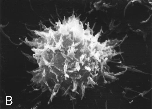 Fig. 2. (A) Phase-contrast micrograph of peripheral blood lymphocytes in HBLD. The cells display striking surface projections. (B) Scanning electron micrograph shows prominent ruffles and long microvilli.