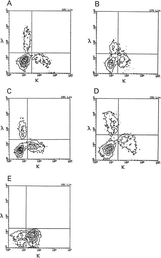 Fig. 3. Two-color immunofluorescence analysis of Igκ and Igλ expression on the cells of patients with HBLD and a patient with HCL-Japanese variant. (A through D) HBLD (cases no. 1 through 4); (E) HCL-Japanese variant.