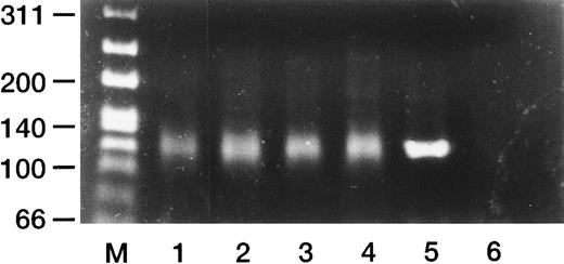 Fig. 5. PCR amplification of Ig heavy chain gene using the consensus VH and JH primers. PCR products from patients with HBLD (cases no. 1 through 4) showed a diffuse smear, indicating a polyclonal B-cell population (lanes 1 through 4). Lane 5, positive control (a patient with precursor B-cell acute lymphocytic leukemia); lane 6, negative control (placental DNA); lane M, size markers.