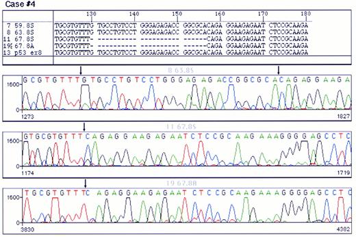 Fig. 2. Analysis of a p53 mutation by PCR direct sequencing using fluorescent termination nucleotides. A chromatogram of control DNA is shown in (A). (B) and (C) correspond to chromatograms of the PCR product of exon 8 of p53 from a mutated case sequenced from both ends. A single base pair substitution (G → T) was detected in this case. Arrows point to the site of mutation. Note that the signal corresponding to the germline nuleotide could not be detected.