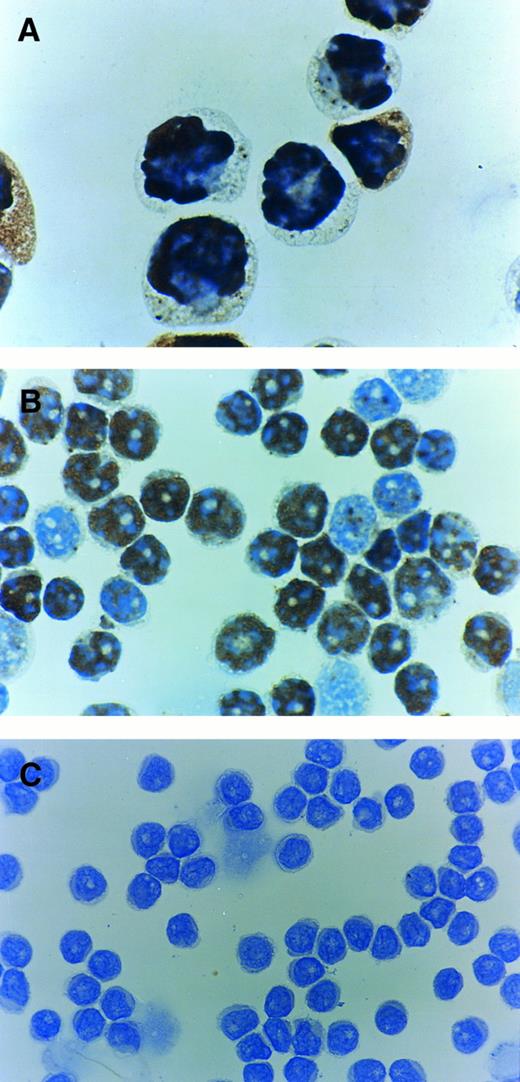 Fig. 4. Immunocytochemistry of p53 protein using PAb1801 antibody. (A) Control positive CEM T-cell line showing most of the cells to be positive. (B) Case with a p53 mutation and with 80% of cells positive. (C) Case which is negative for p53 protein despite exhibiting a p53 mutation.