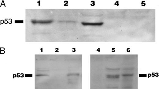 Fig. 5. (A) Immunoblotting with DO-1 antibody. Lane 1, CEM positive control; lane 2, case no. 11 with no p53 mutation; lane 3, case no. 4 with a 27-bp intragenic deletion; lane 4, case no. 10 with a 35-bp deletion; lane 5, case no. 5 with a 5-bp deletion at exon 7 and p53 protein negative by immunocytochemistry. (B) Immunoblotting of whole cell lysates from cases no. 4 (lanes 1 and 5) and case no. 10 (lanes 2 and 4) with PAb 1801 and PAb 421 antibodies. Case no. 4 (lanes 1 and 5) showed a 53-kD band with both antibodies and no band is observed with any of the antibodies in case no. 10 (lanes 2 and 4). Lane 3 and 6 correspond to CEM-positive control. (C) Comparison of the predicted amino acid sequence of case no. 4 with the wild-type p53 protein sequence.