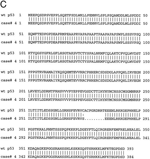 Fig. 5. (A) Immunoblotting with DO-1 antibody. Lane 1, CEM positive control; lane 2, case no. 11 with no p53 mutation; lane 3, case no. 4 with a 27-bp intragenic deletion; lane 4, case no. 10 with a 35-bp deletion; lane 5, case no. 5 with a 5-bp deletion at exon 7 and p53 protein negative by immunocytochemistry. (B) Immunoblotting of whole cell lysates from cases no. 4 (lanes 1 and 5) and case no. 10 (lanes 2 and 4) with PAb 1801 and PAb 421 antibodies. Case no. 4 (lanes 1 and 5) showed a 53-kD band with both antibodies and no band is observed with any of the antibodies in case no. 10 (lanes 2 and 4). Lane 3 and 6 correspond to CEM-positive control. (C) Comparison of the predicted amino acid sequence of case no. 4 with the wild-type p53 protein sequence.