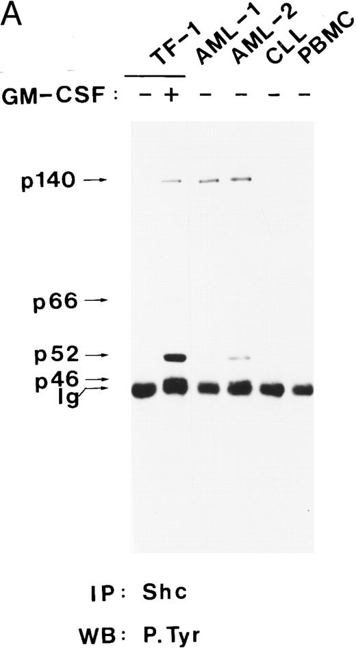 Fig. 4. Shc and p140 are constitutively phosphorylated on tyrosine in AML cells. (A) Cell lysates from unstimulated (−) or hGM-CSF–stimulated (+) TF-1 cells and lysates of primary leukemia cells obtained from two patients with AML (AML-1 and AML-2), CLL, and a lysate of PBMCs obtained from a healthy donor were immunoprecipitated with anti-Shc antibodies and subjected to antiphosphotyrosine immunoblotting (P.Tyr). (B) Anti-Shc immunoprecipitates of lysates from hGM-CSF–stimulated TF-1 cells (lane 1) and primary AML (AML-3 through AML-8; lanes 2 through 7) were analyzed by antiphosphotyrosine immunoblotting. The positions of p52Shc, p66Shc, p61, p140, and p200 are indicated on the left. Molecular weight marker bands are indicated on the right.