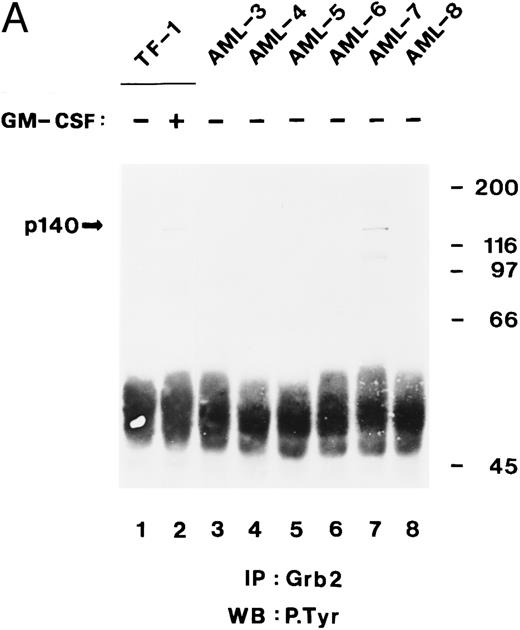 Fig. 8. The C-terminal SH3 domain of Grb2 binds to tyrosine-phosphorylated p140 in AML. (A) p140 is constitutively associated with Grb2 in AML cells. Cell lysates from unstimulated (lane 1) or hGM-CSF–stimulated TF-1 cells (lane 2) and from unstimulated primary leukemia cells obtained from five patients with AML (AML-3 through AML-8; lanes 3 through 8) were immunoprecipitated with anti-Grb2 antibodies followed by antiphosphotyrosine immunoblotting (P.Tyr). The position of p140 is indicated on the left. (B) The C-terminal SH3 domain of Grb2 binds to p140 in AML cells. Cell lysates from unstimulated primary AML cells were incubated with either GST vector protein (GST; AML-3; lane 1) or with GST fusion proteins containing the C-terminal SH3 domain of Grb2 (GST-Grb2-SH3; AML-3 through AML-8; lanes 2 through 7). Associated tyrosine-phosphorylated proteins were analyzed by antiphosphotyrosine immunoblotting (lanes 1 through 7). The AML samples analyzed in this experiment correspond to the AML-3 through AML-8 samples analyzed in (A), lanes 3 through 8, and in Fig 4B, lanes 2 through 7. The position of tyrosine-phosphorylated proteins is indicated on the left. Molecular weight markers are indicated on the right.