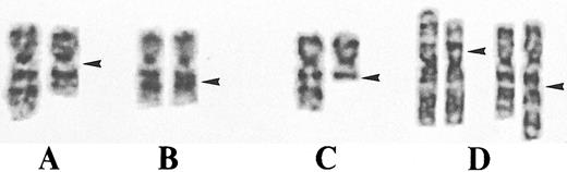 Fig. 1. Representative partial G-banding karyotypes. (A) CML (case no. 1) exhibiting an interstitial deletion del(7)(q11.2q22). (B) CML (case no. 2) with a small interstitial deletion del(7)(q22q22). Note that bands 7q21 and 7q31 are closer to each other in the deleted than in the normal chromosome 7 homolog. (C) MDS (case no. 3) with a terminal deletion del(7)(q22). (D) MDS (case no. 6) exhibiting a reciprocal translocation t(3; 7)(p13; q22) in unstimulated bone marrow and PHA-stimulated blood.