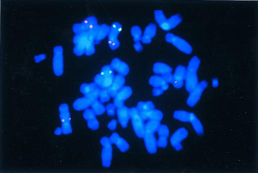 Fig. 3. Identification of the t(3; 7)(p13; q22) in case no. 6 by YAC clone HSC7E572 (Cy3). Note the three red signals that originate from the normal chromosome 7 (upper left), the derivative 7 (lower left), and the derivative 3 chromosome (upper right). For the identification of chromosome 3, we cohybridized with a YAC clone (fluorescein isothiocyanate) mapping to the long arm of chromosome 3.