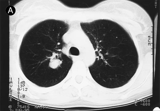 Fig. 1. Response to HRS-3/A9 treatment of patient no. 7. Computed tomography (CT) scans of a pulmonary infiltration with HD in the right lung just above the tracheal bifurcation level is shown before (A) HRS-3/A9 therapy and (B) 5 weeks after the last BiMoAb infusion (4 mg/m2 × 4). The response was determined a mixed response because the partial response in the lung was accompanied by the simultaneous growth of peripheral lymph nodes.