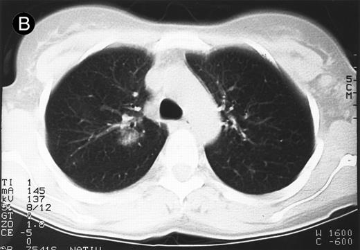 Fig. 1. Response to HRS-3/A9 treatment of patient no. 7. Computed tomography (CT) scans of a pulmonary infiltration with HD in the right lung just above the tracheal bifurcation level is shown before (A) HRS-3/A9 therapy and (B) 5 weeks after the last BiMoAb infusion (4 mg/m2 × 4). The response was determined a mixed response because the partial response in the lung was accompanied by the simultaneous growth of peripheral lymph nodes.