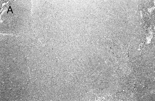 Fig. 2. Composite photograph showing the three low-power architectural patterns observed in MCL and their prognostic significance: (A) Diffuse pattern; (B) nodular pattern; and (C) MZ pattern. (D) OS of 80 patients based on the predominant architectural pattern observed at diagnosis. No significant differences in OS were shown.