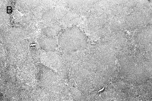 Fig. 2. Composite photograph showing the three low-power architectural patterns observed in MCL and their prognostic significance: (A) Diffuse pattern; (B) nodular pattern; and (C) MZ pattern. (D) OS of 80 patients based on the predominant architectural pattern observed at diagnosis. No significant differences in OS were shown.