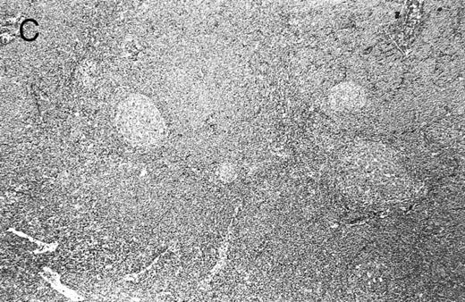 Fig. 2. Composite photograph showing the three low-power architectural patterns observed in MCL and their prognostic significance: (A) Diffuse pattern; (B) nodular pattern; and (C) MZ pattern. (D) OS of 80 patients based on the predominant architectural pattern observed at diagnosis. No significant differences in OS were shown.