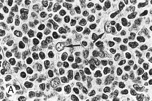Fig. 3. Composite photograph showing the cytologic features of MCL. (A) Typical cytology of MCL characterized by cells with small, slightly irregular nuclei, inconspicuous nucleoli, and minimal cytoplasm. Note the frequent epithelioid histiocytes (arrows). (B) MCL with prominent features of transformation, but not clearly blastic. Increased numbers of larger cells with fine chromatin and inconspicuous nucleoli are shown (arrows). (C) Blastic MCL. Note the cytologic resemblance to lymphoblastic lymphoma. (D) OS of 80 patients with MCL based on the presence of blastic features. The 5 cases designated as blastic MCL were associated with a significantly shorter survival when compared with that of all others (n = 75) including those with features of transformation as shown in (B).