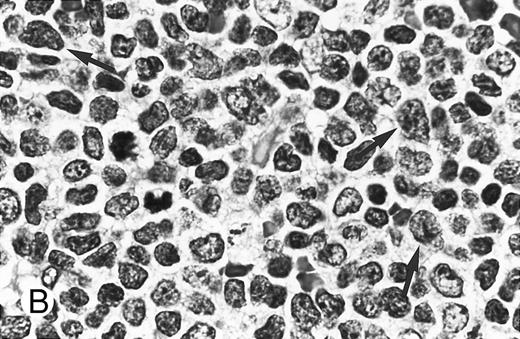 Fig. 3. Composite photograph showing the cytologic features of MCL. (A) Typical cytology of MCL characterized by cells with small, slightly irregular nuclei, inconspicuous nucleoli, and minimal cytoplasm. Note the frequent epithelioid histiocytes (arrows). (B) MCL with prominent features of transformation, but not clearly blastic. Increased numbers of larger cells with fine chromatin and inconspicuous nucleoli are shown (arrows). (C) Blastic MCL. Note the cytologic resemblance to lymphoblastic lymphoma. (D) OS of 80 patients with MCL based on the presence of blastic features. The 5 cases designated as blastic MCL were associated with a significantly shorter survival when compared with that of all others (n = 75) including those with features of transformation as shown in (B).