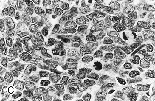 Fig. 3. Composite photograph showing the cytologic features of MCL. (A) Typical cytology of MCL characterized by cells with small, slightly irregular nuclei, inconspicuous nucleoli, and minimal cytoplasm. Note the frequent epithelioid histiocytes (arrows). (B) MCL with prominent features of transformation, but not clearly blastic. Increased numbers of larger cells with fine chromatin and inconspicuous nucleoli are shown (arrows). (C) Blastic MCL. Note the cytologic resemblance to lymphoblastic lymphoma. (D) OS of 80 patients with MCL based on the presence of blastic features. The 5 cases designated as blastic MCL were associated with a significantly shorter survival when compared with that of all others (n = 75) including those with features of transformation as shown in (B).