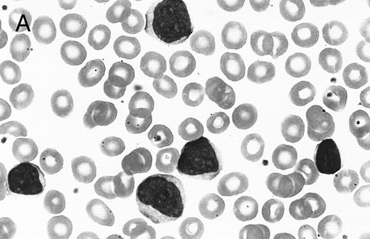 Fig. 5. (A) PB involvement in MCL is characterized by a polymorphous cell population including larger cells with immature nuclei and prominent nucleoli. (B) OS of 80 cases of MCL based on PB involvement at diagnosis. Those cases positive for PB involvement (n = 27) were associated with a significantly shorter survival when compared with those in which PB was not involved or not assessed (n = 53).