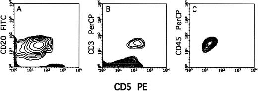 Fig. 1. Typical staining of T cells (CD3+CD5+) and tumor cells (CD20+CD5+) in PBMC of lymphocytes from a BCLL donor before transplantation.