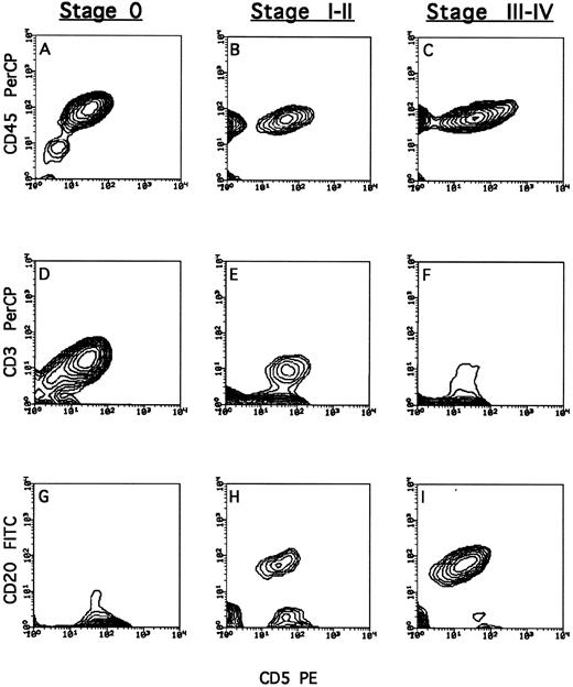 Fig. 3. Phenotypic characterization of lymphocytes recovered from human-<Balb/c chimera. Chimera were prepared by conditioning Balb/c mice with split irradiation followed by radioprotection with SCID BM; thereafter, the mice were transplanted with 100 to 1,000 × 106 human PBMC from BCLL patients. Cells were recovered from the peritoneum wash 14 days after transplantation. The total population of human lymphocytes (A, B, and C) was typed by staining with anti-CD45. T cells (D, E, and F ) were typed by triple staining of CD45+ cells with anti-CD3 and anti-CD5. BCLL cells (G, H, and I) were typed by triple staining of CD45+ cells with anti-CD20 and anti-CD5. Typical FACS analysis of cells from chimeric mice generated from patients in stage 0, I to II, and III to IV disease; patients no. 5 (A, D, and G), 20 (B, E, and H), and 18 (C, F, and I), respectively.