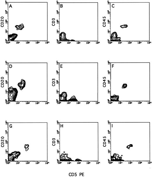 Fig. 4. Typical organ distribution of human lymphocytes in human/mouse chimera following transplantation of PBMC from a stage II BCLL patient with prolymphocytic features. Human/mouse chimera were prepared as described in Fig 2. Two weeks after transplantation of human BCLL cells, mice were killed, and the recovered cells from different organs were isolated on Ficoll and tested by cytofluorometry for triple staining with anti-CD45, anti-CD3, and anti-CD20. Shown are cells recovered from the spleen (A, B, and C), liver (D, E, and F ), and lung (G, H, and I) of a chimera generated from patient no. 20.