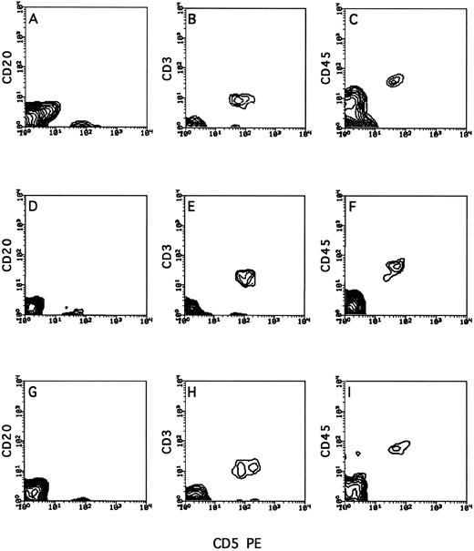 Fig. 5. Typical organ distribution of human lymphocytes in human/mouse chimera following transplantation of PBMC from a stage 0 BCLL patient. Human/mouse chimera were prepared as described in Fig 2. Two weeks after transplantation of human BCLL cells, mice were killed, and the recovered cells from different organs were isolated on Ficoll and tested by cytofluorometry for triple staining with anti-CD45, anti-CD3, and anti-CD20. Shown are cells recovered from the spleen (A, B, and C), liver (D, E, and F ), and lung (G, H, and I) of a chimera generated from patient no. 2.