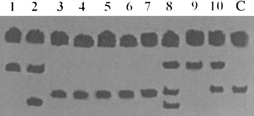 Fig. 3. SSCP analysis of exon 13 of the hMSH2 gene in 10 cases of human LBL. Lanes 1 through 10 represent cases of human LBL and lane 11 represents normal human DNA. Conformational band shifts representing mutational change are seen in lanes 1, 2, and 8 through 10.