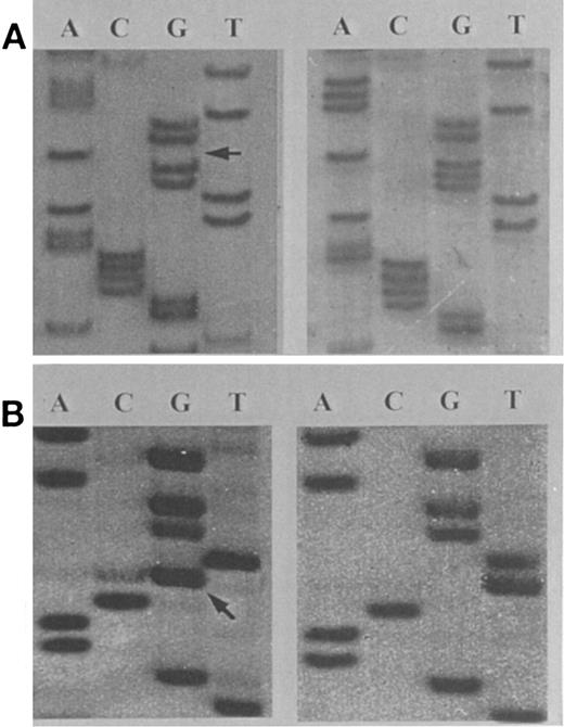 Fig. 4. Sequence analysis of amplification products of exon 13 of the hMSH2 gene in human LBL (A and B). (A) A patient with a heterozygous frameshift mutation resulting from a 1-bp deletion at codon 672-673. (B) A patient with a heterozygous missense C → A mutation at codon 724, displayed in an antisense configuration. The locations of the mutations are indicated with arrows.