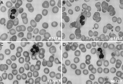 Fig. 1. Platelet morphology. PB smears were stained with May-Grünwald-Giemsa (original magnification × 800) for the normal control (A), the father (B), the mother (C), and the patient (D). The father had normal-sized platelets, whereas platelet size varied in the mother. Bottom right inset of each panel shows the platelet volume (fL) and size (μm), respectively.