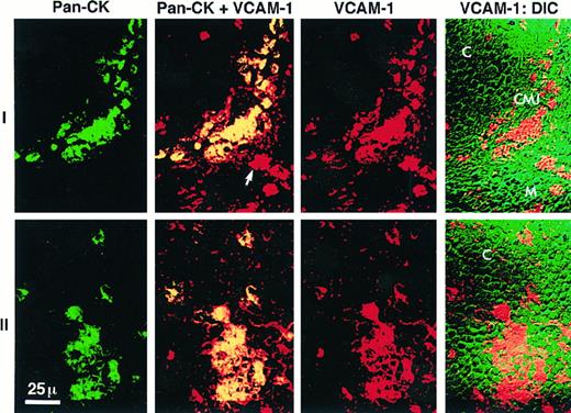Fig. 6. Laser scanning confocal microscopy of cytokeratin and VCAM-1 expression in the human thymus. Frozen sections of human thymus were labeled with a directly-FITC labeled pan-cytokeratin MoAb (KL-1) shown in green and an anti-VCAM-1 MoAb (1G11) indirectly stained with a LRSC-labeled secondary antibody shown in red. The last panel of each series is the differential interference contrast image (DIC), which allows the localization of staining in the thymus based on morphological criteria. Series I depicts a representative field at the corticomedullary junction (CMJ) identified at the intersection of the cortex (C) and medulla (M). Series II depicts the cortex. The first image in each series is the pan-cytokeratin staining (Pan-CK, green). The second image is the computer-merged view of both pan-cytokeratin and VCAM-1 staining in which the yellow color represents colocalization of both antibodies (yellow = green + red). The third image of each series is the VCAM-1 staining (VCAM-1, red). The majority of cytokeratin staining in the CMJ and C is colocalized with VCAM-1 consistent with the expression of VCAM-1 by TECs. The fourth image is the DIC view merged with the VCAM-1 staining in red. In the second image of series 1 (Pan-CK + VCAM-1) an arrow marks a VCAM-1 positive cell in the medulla that is pan-cytokeratin negative.