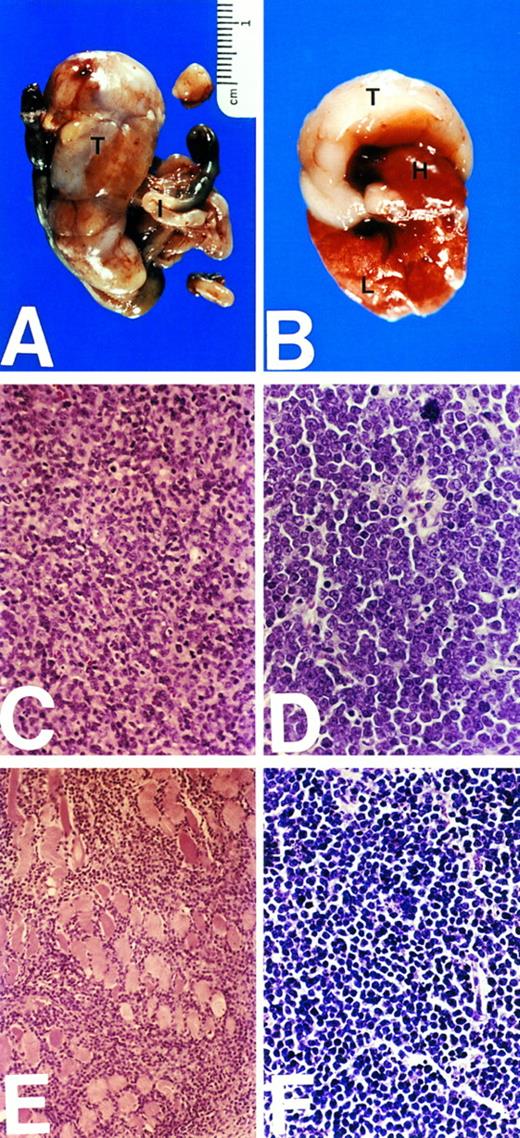 Fig. 6. Development of lymphoma in transgenic mice. (A) and (B) depict the gross appearance of malignant lymphomas developed in transgenic mice. In (A), the tumor (T) was abdominal and compressed, but did not invade the intestines (I). In (B), the tumor (T) involved the thymus and invaded lungs (L) and heart (H). (C) and (D) show representative histologic sections of the tumors shown in (A) and (B), respectively. Diffuse small lymphocytic (low-grade) lymphoma is seen in the abdominal tumor, and a more aggressive lymphoma with open chromatin (lymphoblastic-like) is seen in the thymus tumor. (E) Shows lymphoma invading skeletal muscles. (F ) Shows another pattern of lymphoma observed in abdominal tumors with small cells and condensed chromatin.