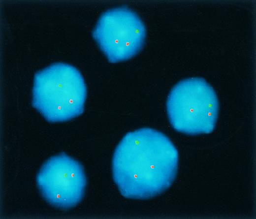 Fig. 2. Hybridization of clone 755b11 (detected via fluoroscein isothiocyanate) and an internal control (detected via Cy3) to nuclei from a B-CLL tumor exhibiting an 11q deletion. All nuclei show only one hybridization signal with the diagnostic 755b11 FISH probe indicating deletion of the corresponding region.