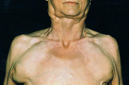 Fig. 3. Patient with B-CLL and 11q deletion suffering from massive lymph node enlargement. Extensive lymphadenopathy characterized the clinical course of the disease in almost all patients.