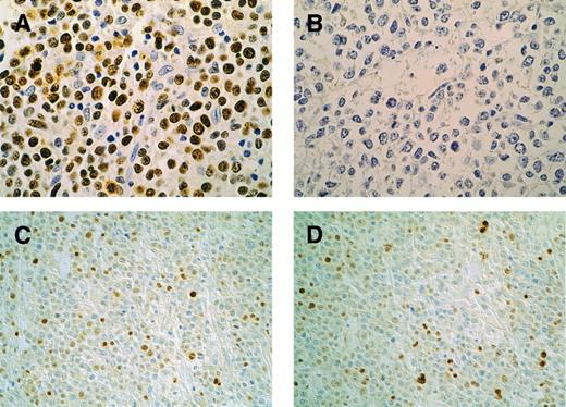 Fig. 1. Patterns of p53 and p21 immunohistochemical expression in high-grade lymphomas. Case F12, p53-mutated case: p53 overexpression in the majority of neoplastic cells (A); coupled with absent p21 (B). Original magnification × 400. Case F8, p53-nonmutated case: p53 is present in 25% of lymphomatous cells (C); p21 expression in a similar percentage of cells (D). Original magnification × 200. DO7 (p53) and EA10 (p21) MoAb. Streptavidin-peroxidase method with DAB; light hematoxylin counterstain.