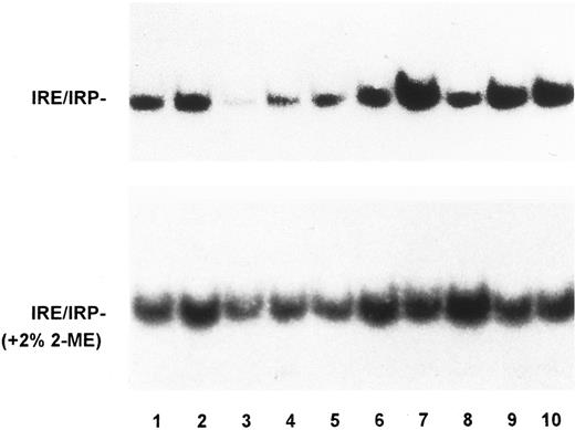 Fig. 1. IRP activity in monocytes of controls, GH and SH patients. Autoradiogram of a representative RNA-bandshift assay. Lysates of monocytes from controls (lanes 1 and 2), patients with SH due to sporadic PTC (lane 3), and unrelated GH patients treated (lanes 4 to 6) and untreated (lanes 7 to 10), were incubated with a 32P-labeled riboprobe spanning the IRE of the ferritin H chain in the absence (top panel) or presence (bottom panel) of 2% 2-mercaptoethanol. RNA-protein complexes were separated on nondenaturing acrylamide gels as described in Materials and Methods. The exposure time of the autoradiogram shown in the top panel was twice longer. IRP activity was higher in untreated GH patients than in controls and SH patients, whereas no significant difference was found between treated GH patients and controls.