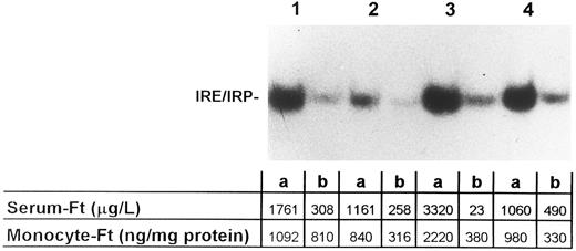 Fig. 3. Effect of phlebotomy on IRP activity in monocytes of GH patients. Monocytes from four unrelated GH patients were isolated before (a) and during (b) phlebotomy treatment and lysates were assayed for IRP activity as described in the legend to Fig 1. The bottom panels report values of serum and monocyte ferritin of the individual subjects. The former were obtained at the time of blood sampling for buffy-coat preparation, the latter were determined in the extract used for bandshift analysis using a radioimmunoassay kit as described in Materials and Methods. Phlebotomy caused a decrease of IRP activity in parallel with reductions of both serum and monocyte ferritin content.